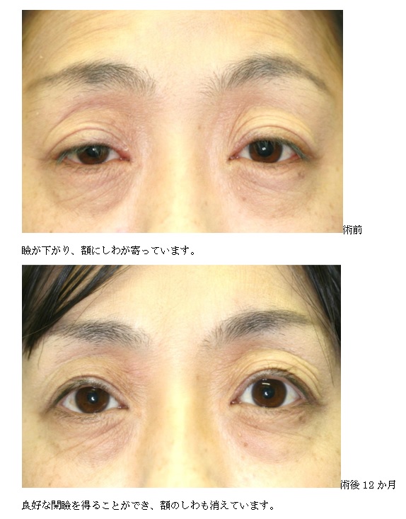 腱膜性眼瞼下垂