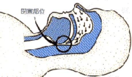 睡眠時無呼吸(閉塞型)