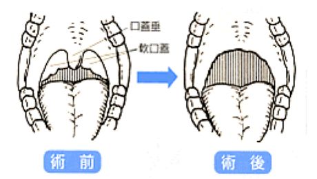 レーザー手術