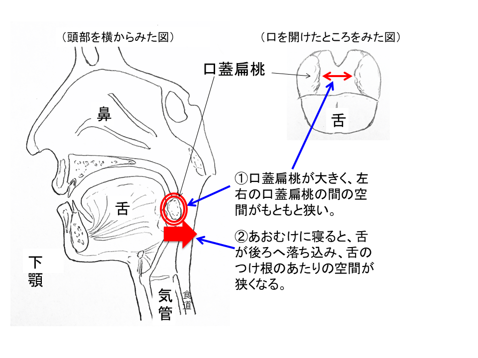 閉塞性睡眠時無呼症(OSA)の原因