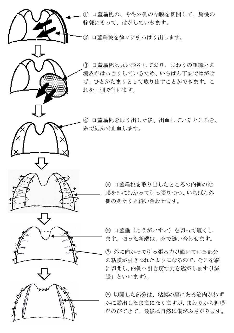 どんなやり方で手術をするのか