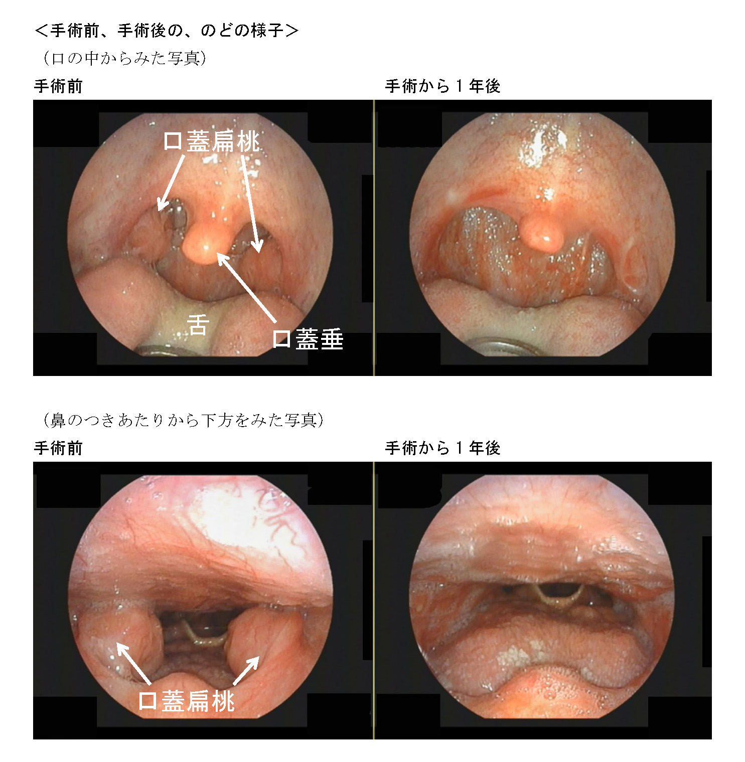 手術前、手術後の、のどの様子