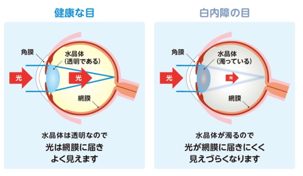 白内障の症状
