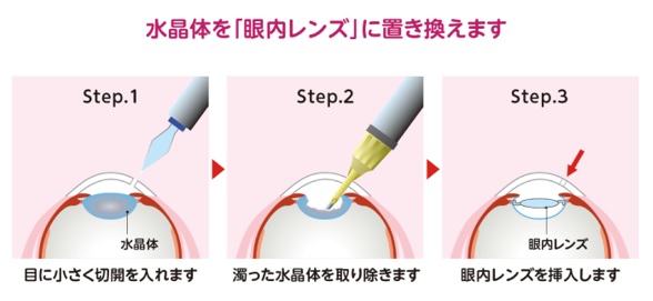 手術について